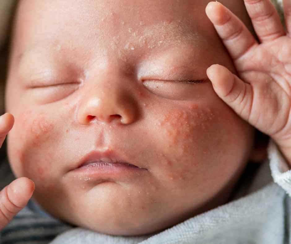 eczema first aid baby