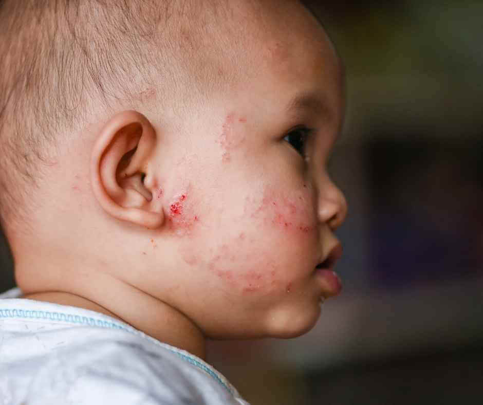 eczema in a baby