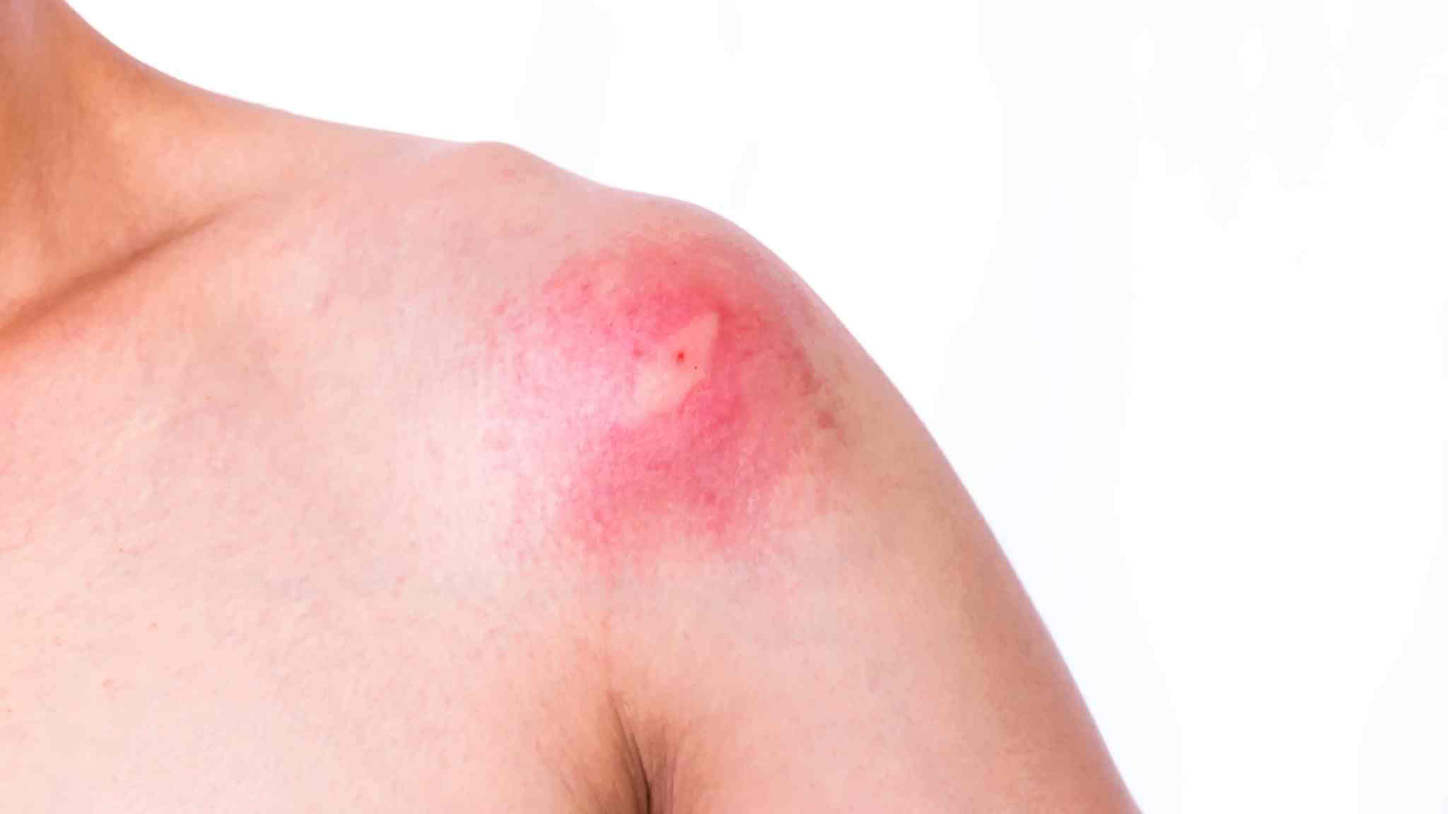 First Aid For A Bee Sting And Other Insect Bites The First Aid Nest