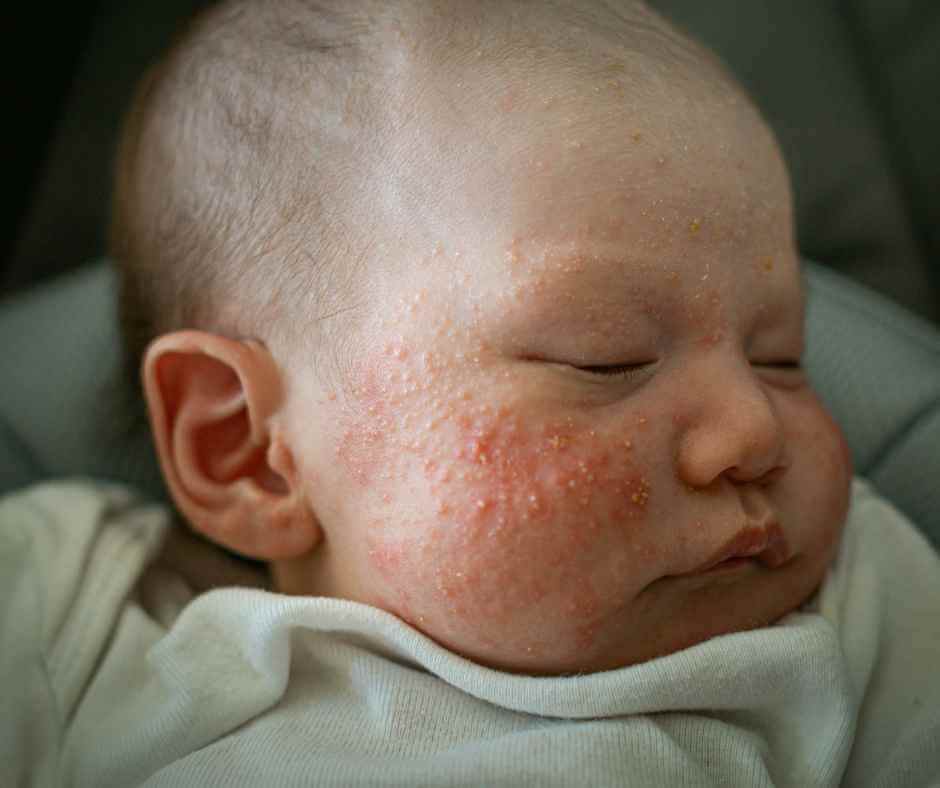 eczema on baby