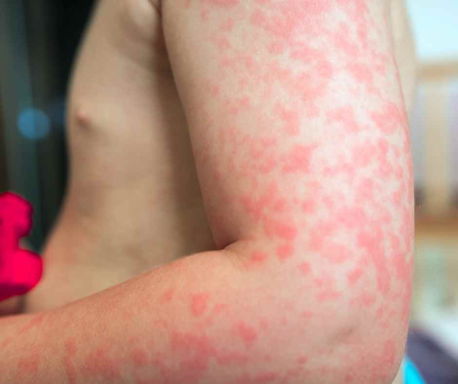 hives-baby-allergy