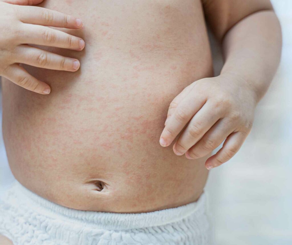 My Baby Has A Rash, What Should I Do? | The First Aid Nest