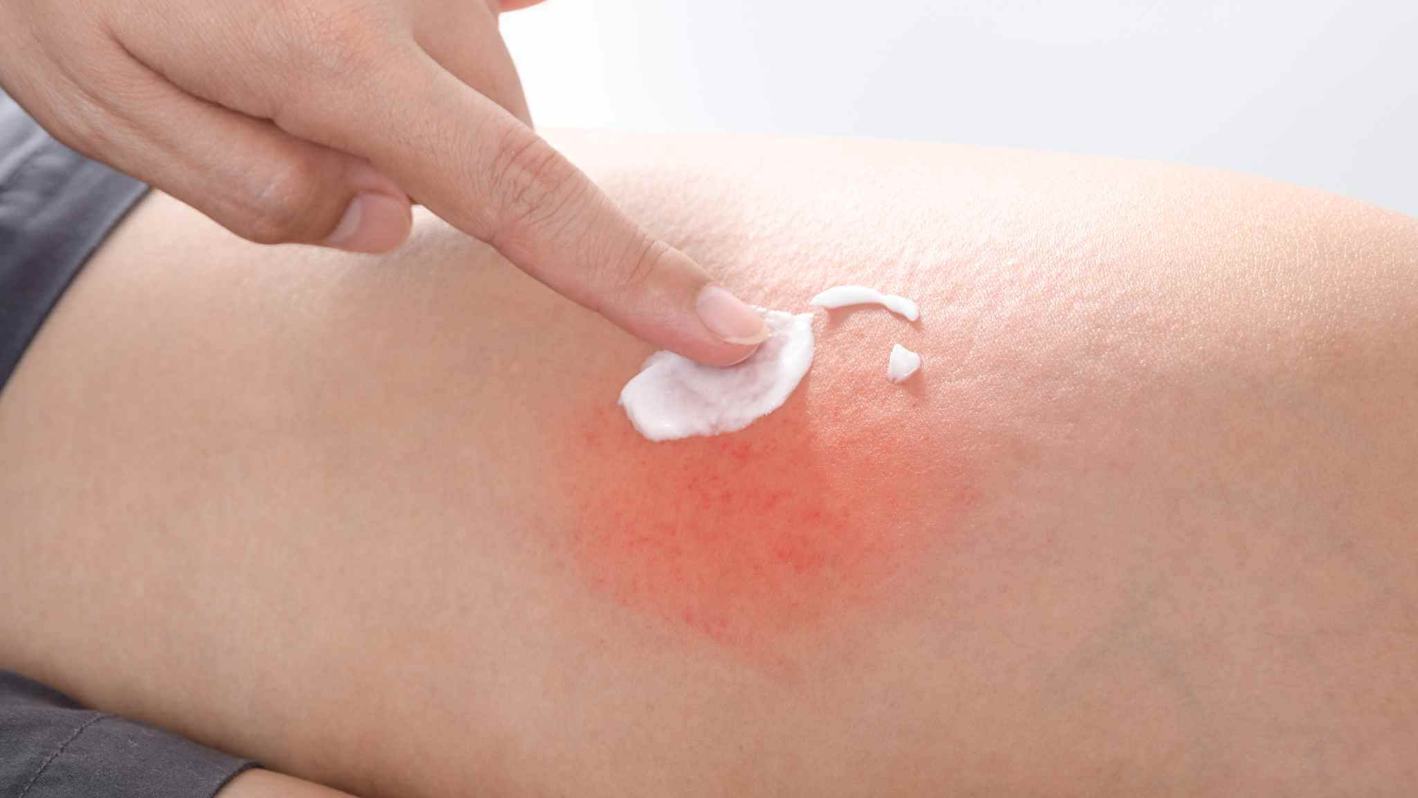 First Aid For Australian Spider Bites The First Aid Nest