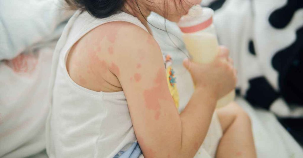 Recognizing and Responding to Allergic Reactions