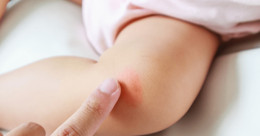Identifying Different Types of Rashes in Infants