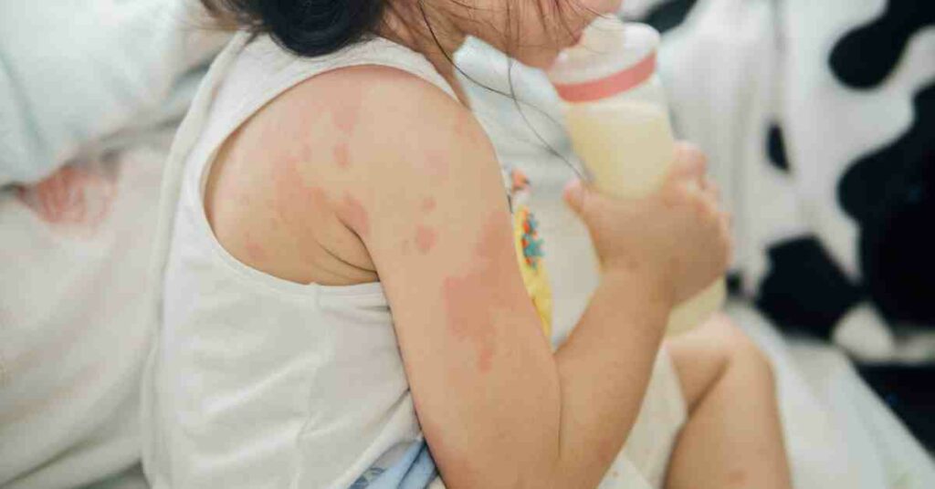 child-allergy-reaction-warning-signs.