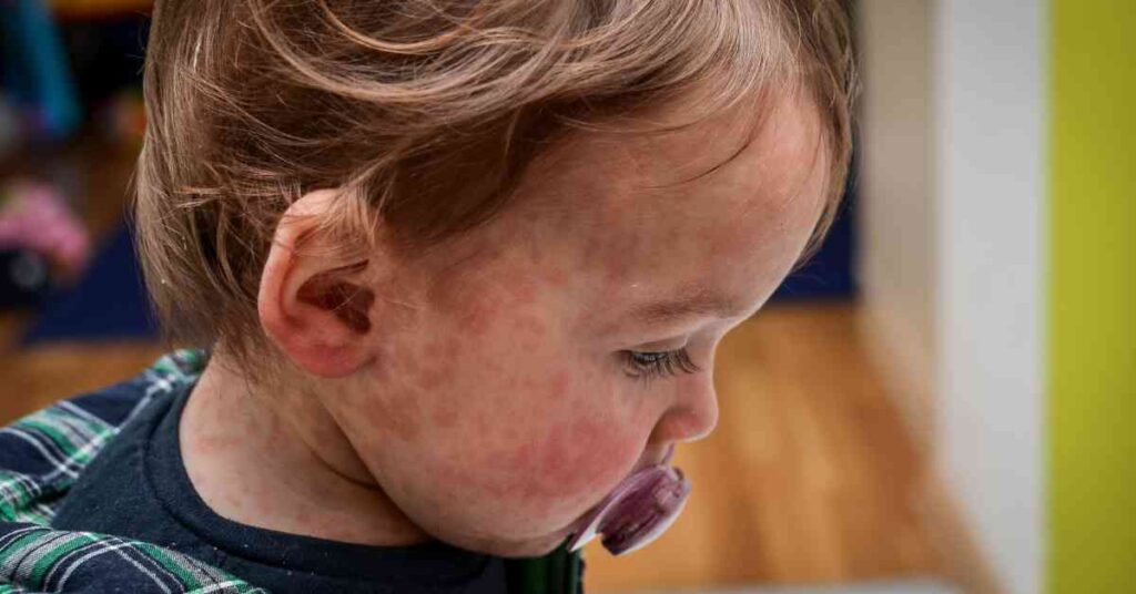 Allergic Reactions in Babies: Prevention and First Aid Tips