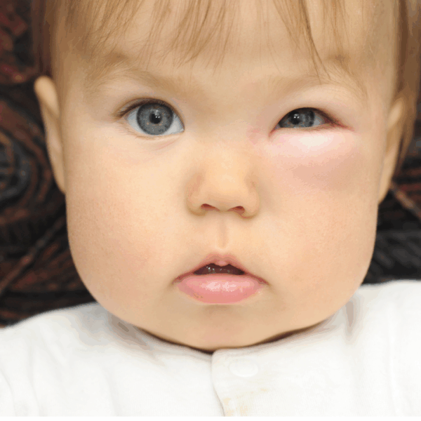 food allergy membership