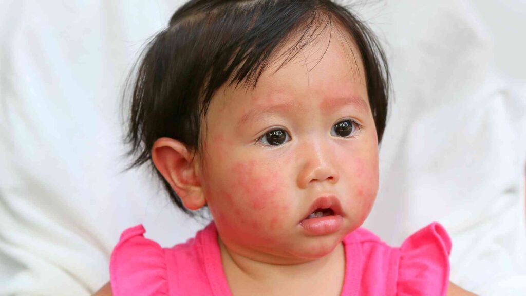 baby allergy